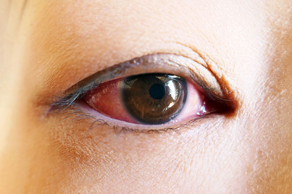 結膜炎のイメージ画像